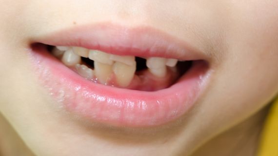23/03/2026 Paediatric Dental Trauma