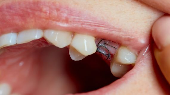 27/02/2026 – Surgical Set Up & Suture Removal for Dental Care Professionals