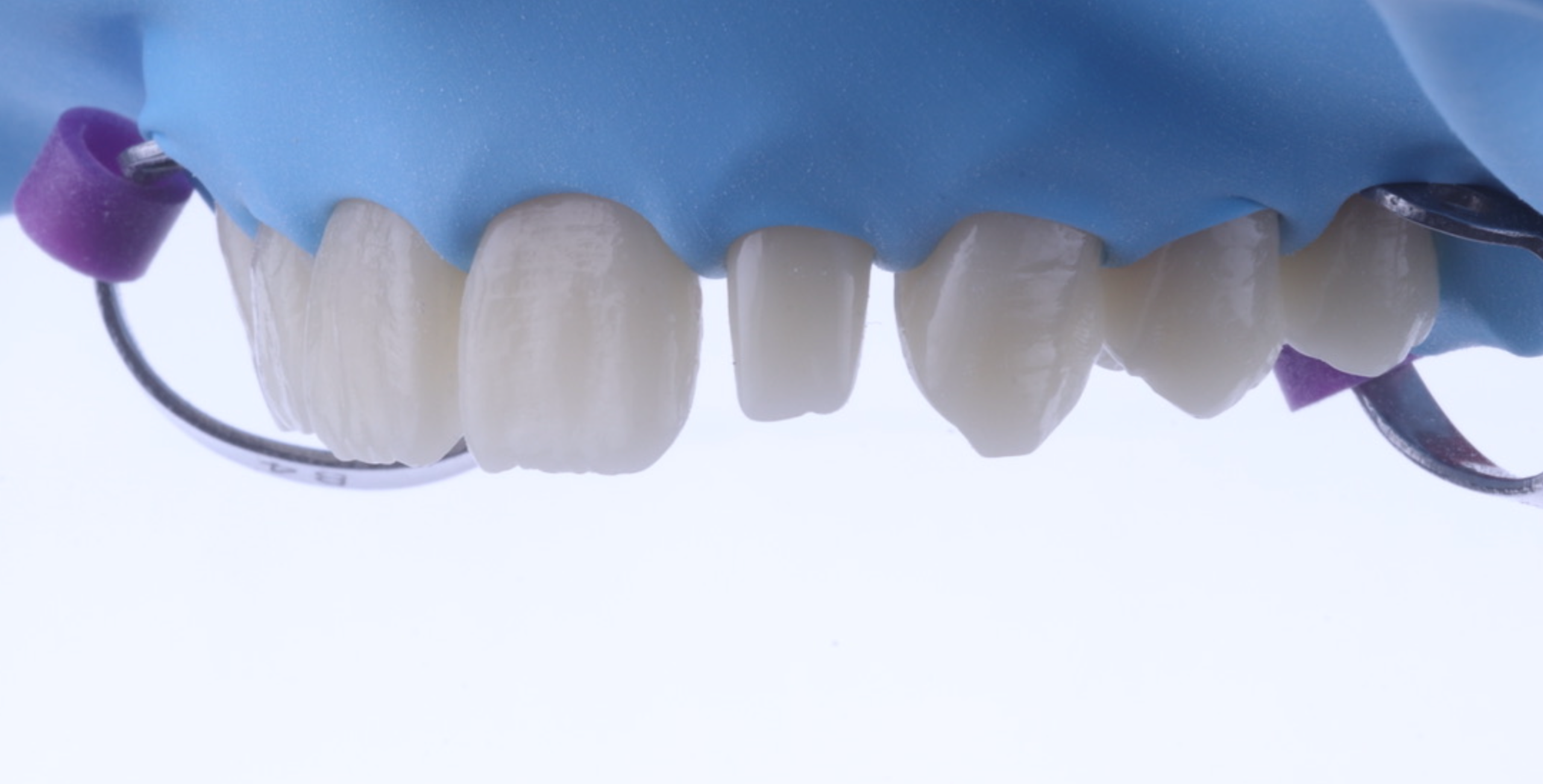 07/05/2026 Composite Veneer Workshop