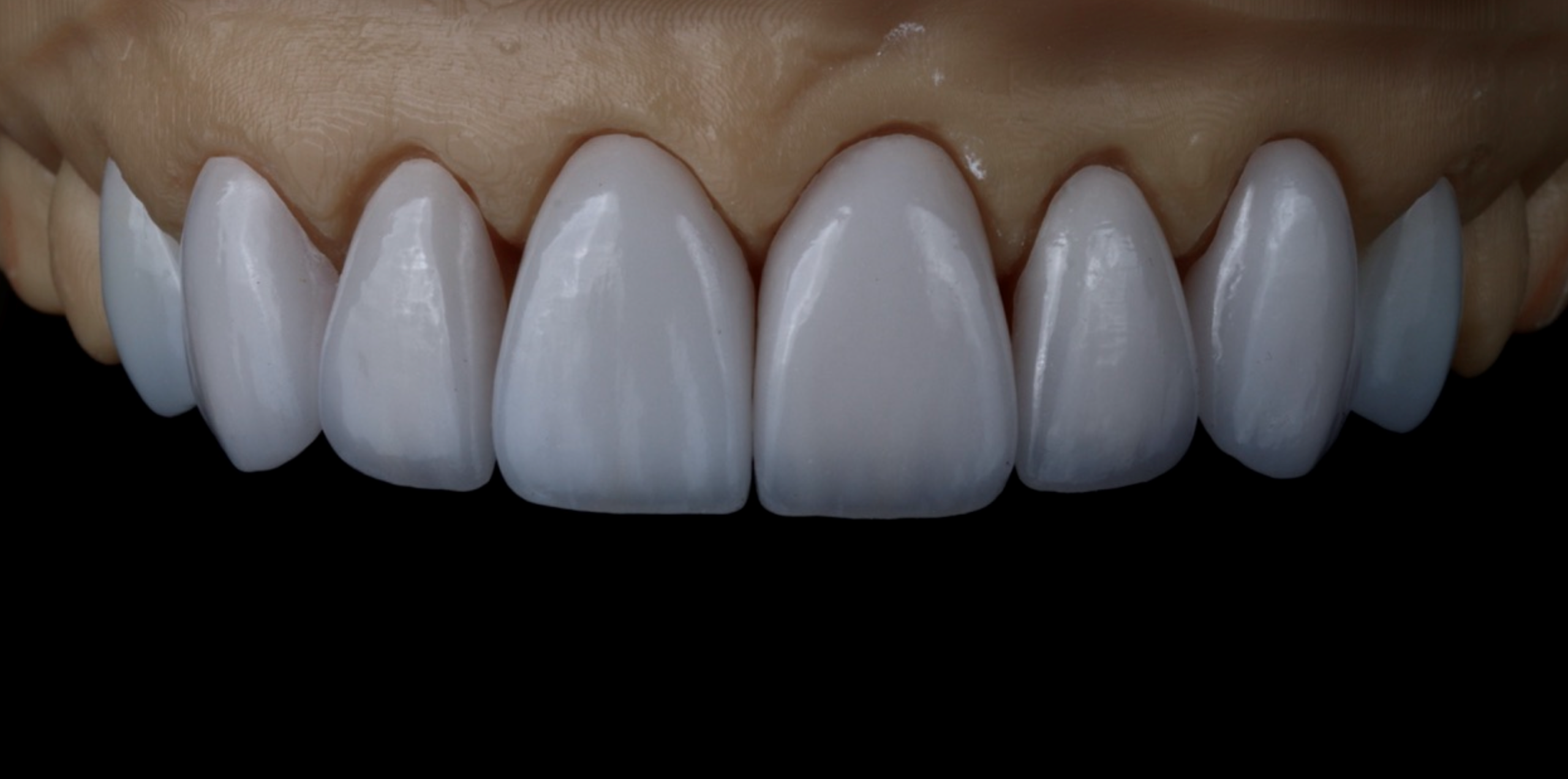 08/05/2026 Porcelain Veneer Workshop