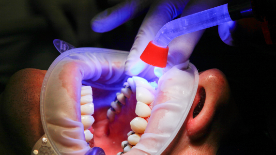 17/06/2026 Anterior Composites