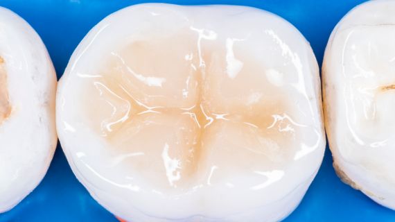 18/06/2026 Posterior Composites