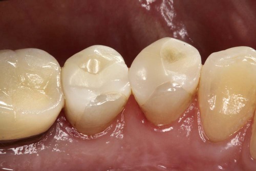 02/06/2026 – Indirect Restorations – Cementation and a Mixture of Restorative Techniques – Clinical Steps for the Provision of Acrylic and Cobalt-Chrome Framework