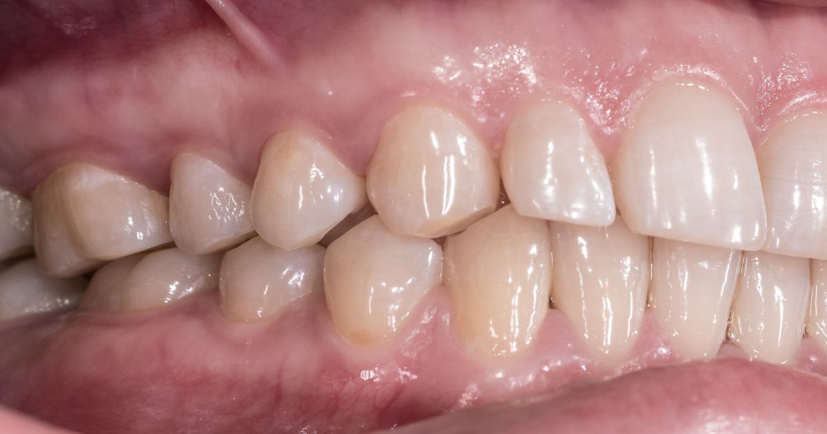 25/02/2027 Occlusion