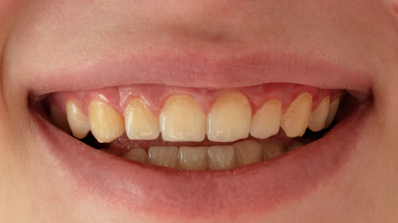 19/05/2026  Plaque Indices