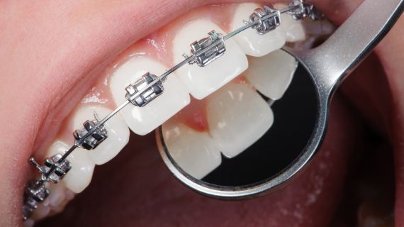 07/10/2026 Orthodontic diagnosis, IPR, referral